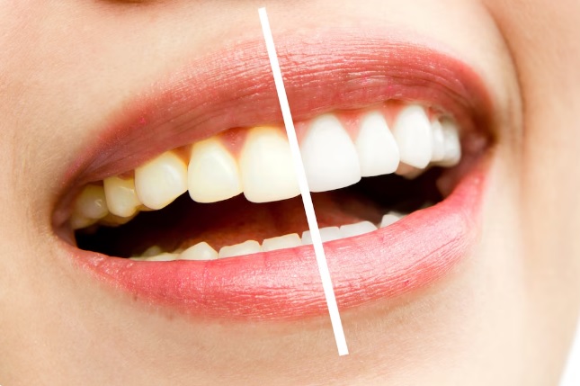 Co warto porównać przed decyzją, czy wybrać domowe, czy profesjonalne wybielanie zębów?